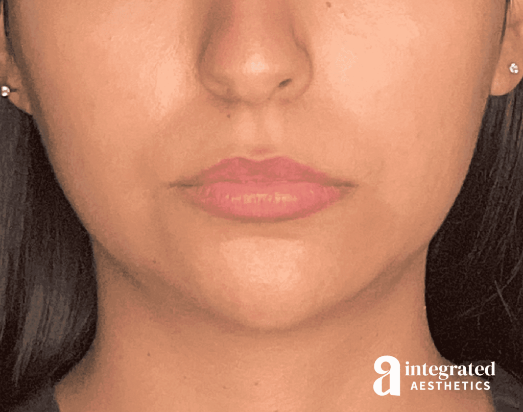 Dermal Fillers