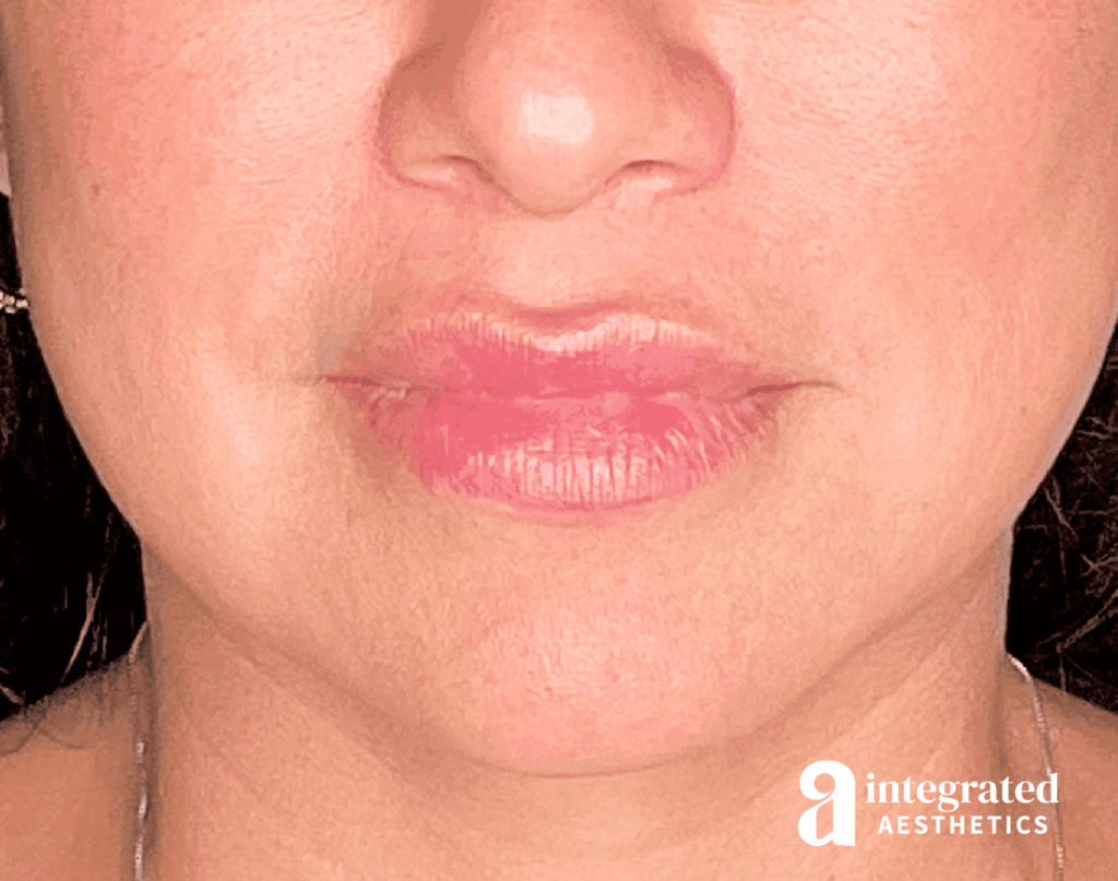 Dermal Fillers