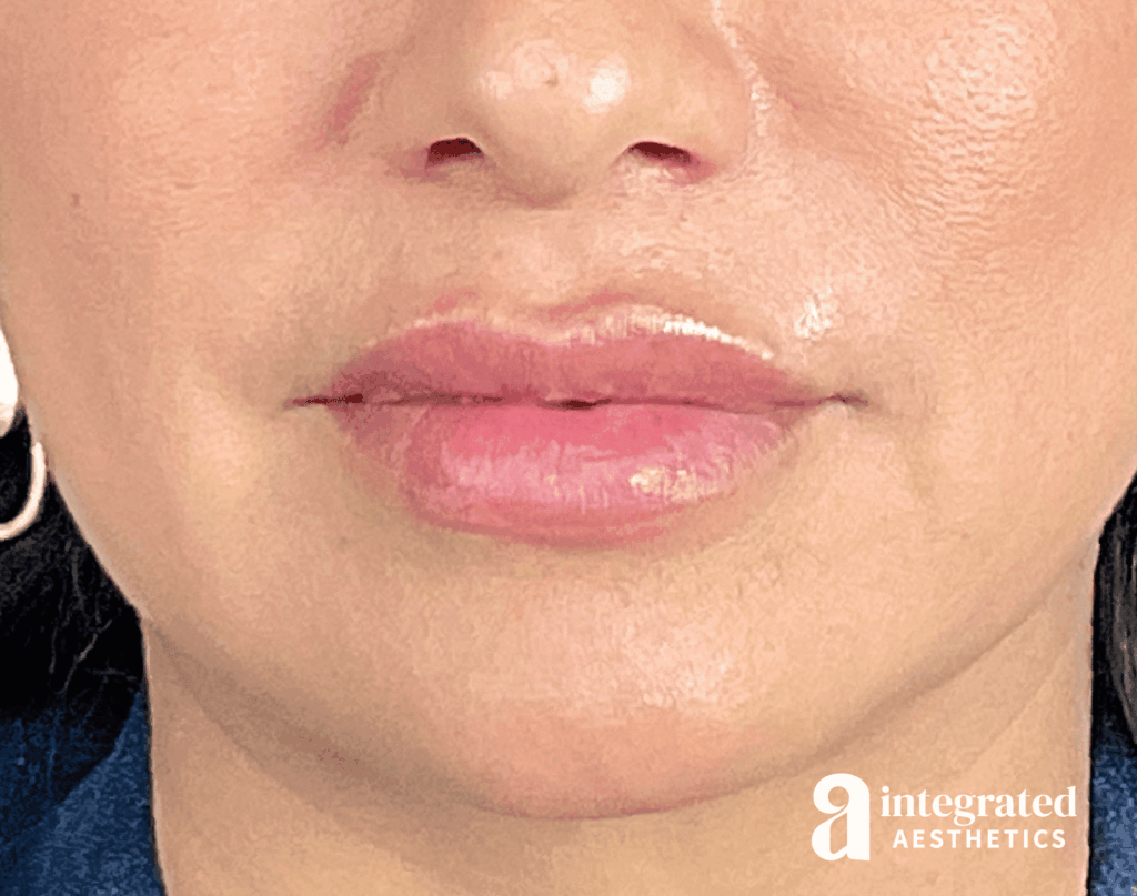Dermal Fillers