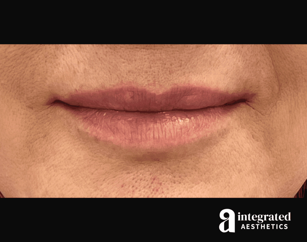 Dermal Fillers