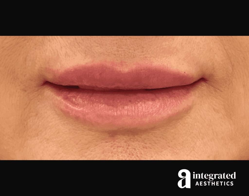 Dermal Fillers