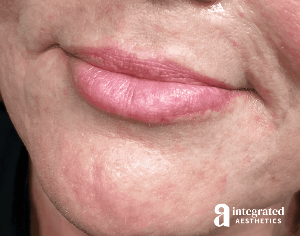 Lip Filler