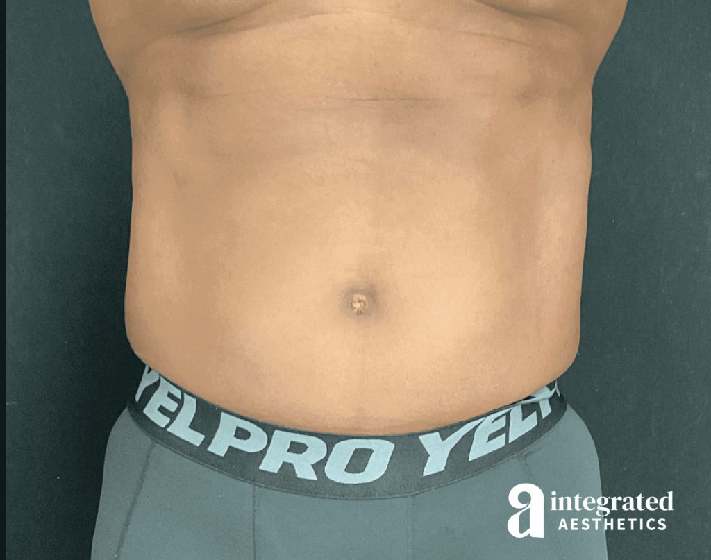 EmSculpt