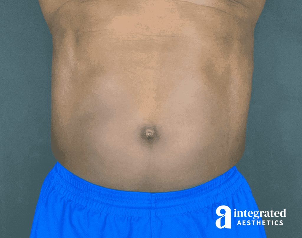 EmSculpt