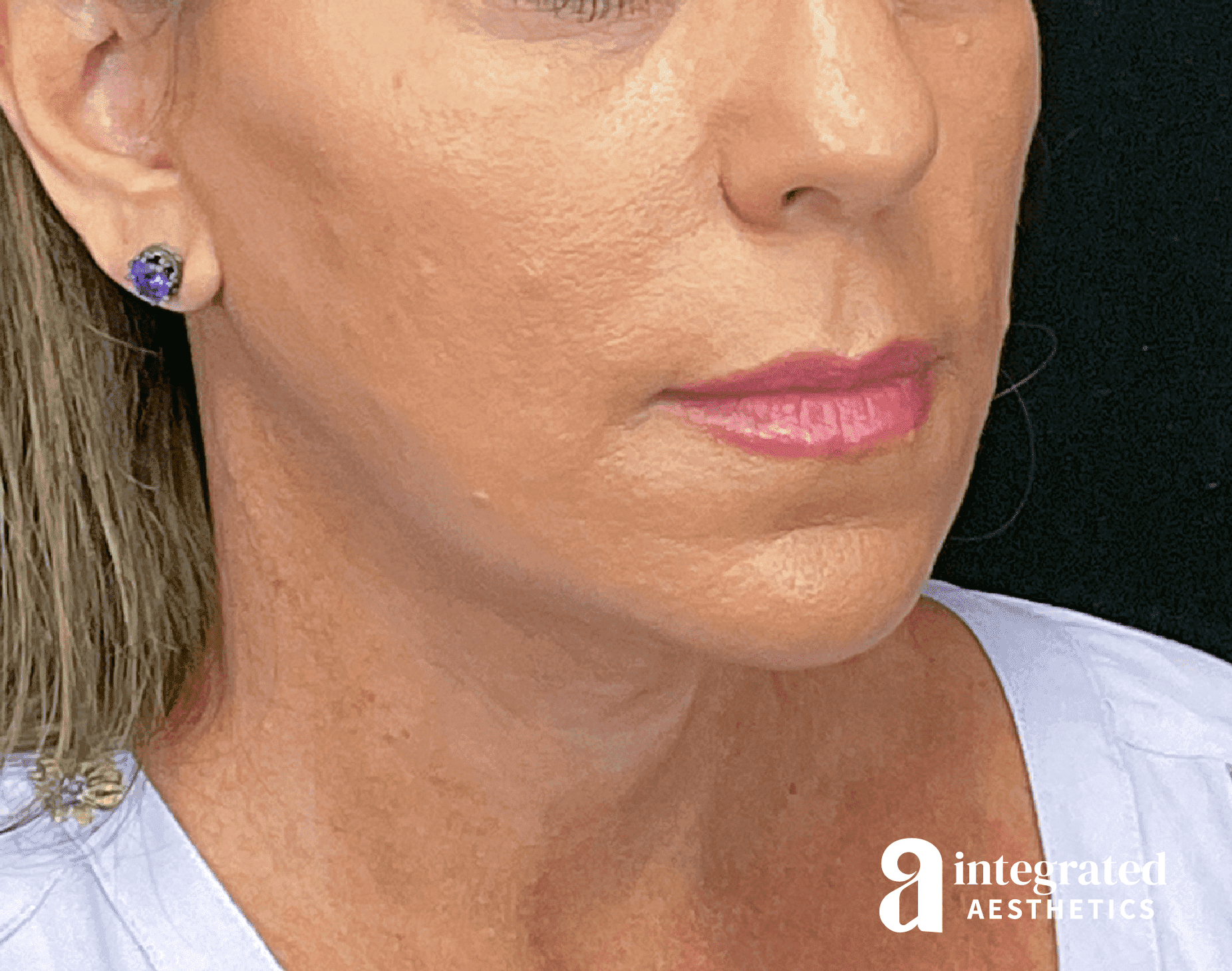Facelift & Neck Lift