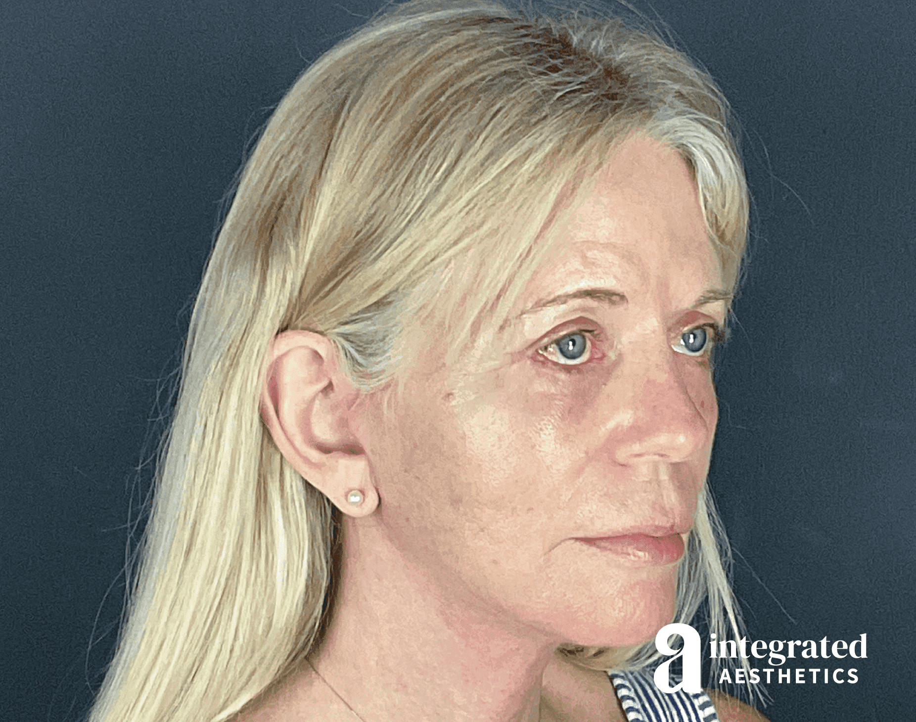 Natural looking facelift result with smoothed wrinkles below the eye and in the midface, tightened jawline and neck