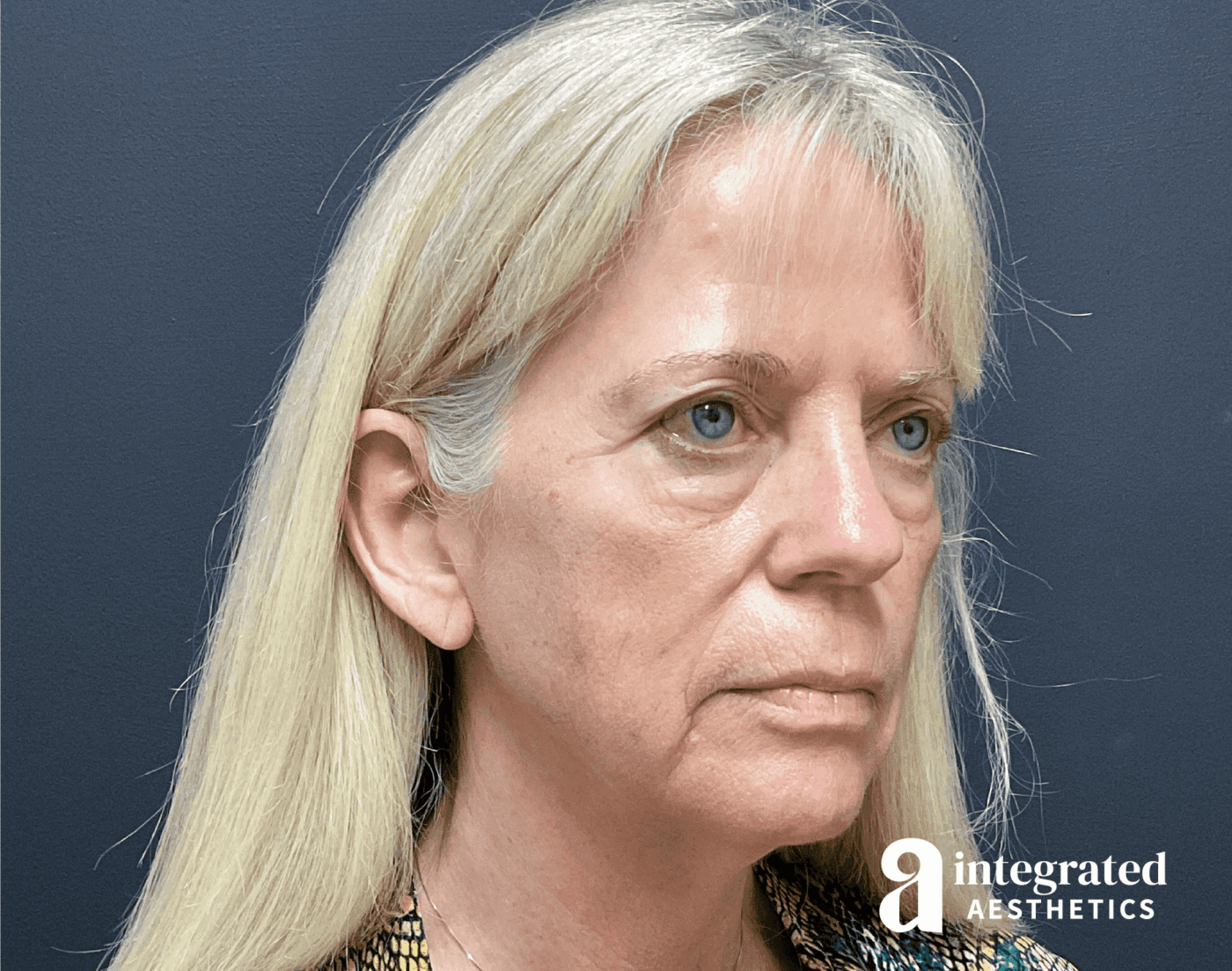 Facelift patient before surgery with marionette lines, some jowls, and wrinkles