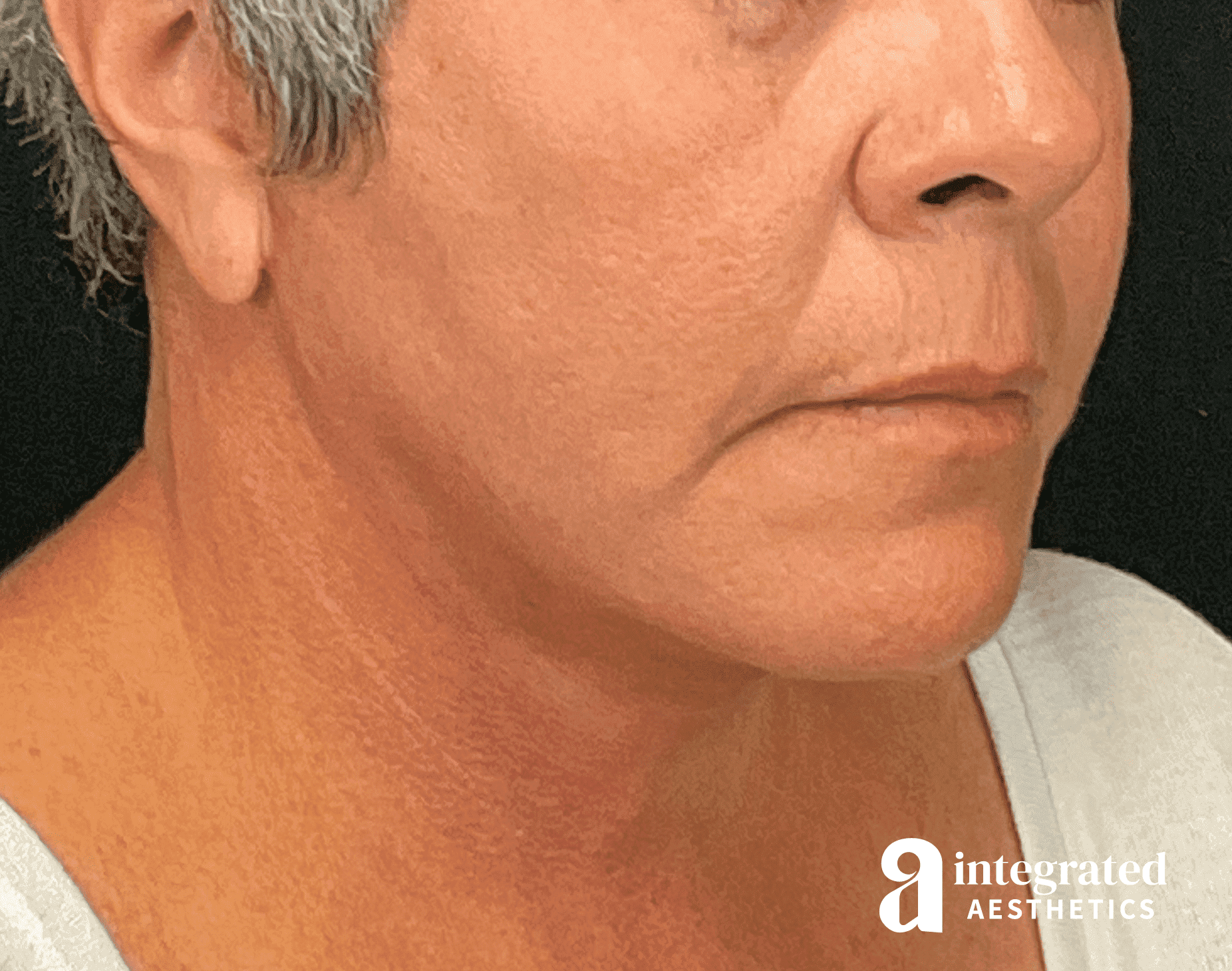 after neck and jaw tightening surgery