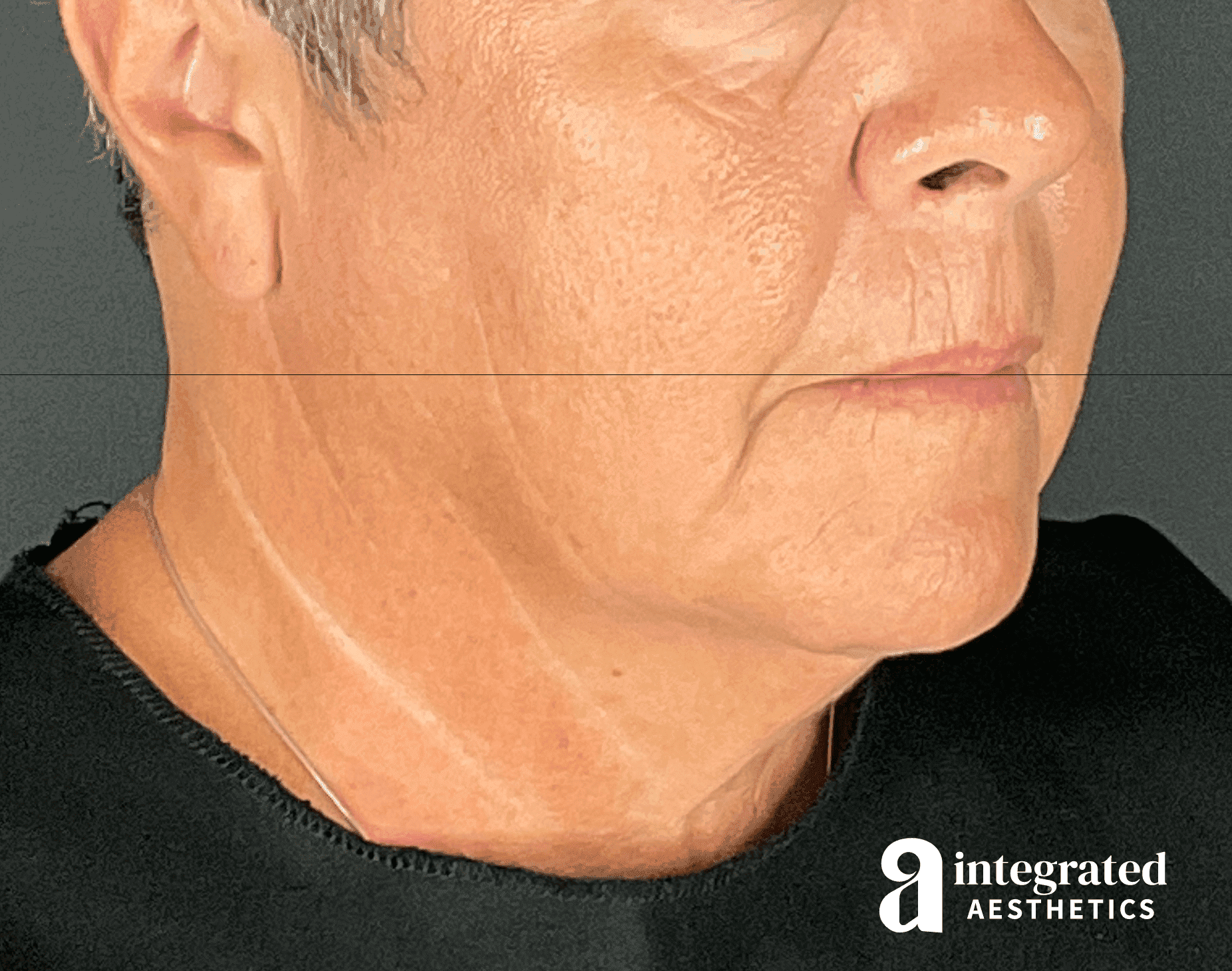 before neck and jaw tightening surgery