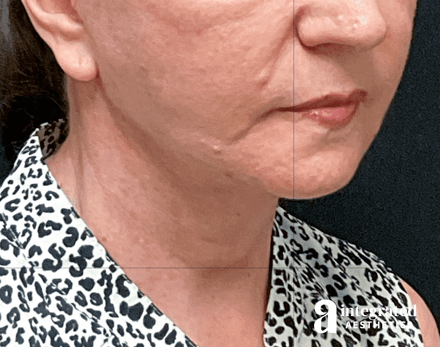 After lower facelift and neck lift for tissue descent