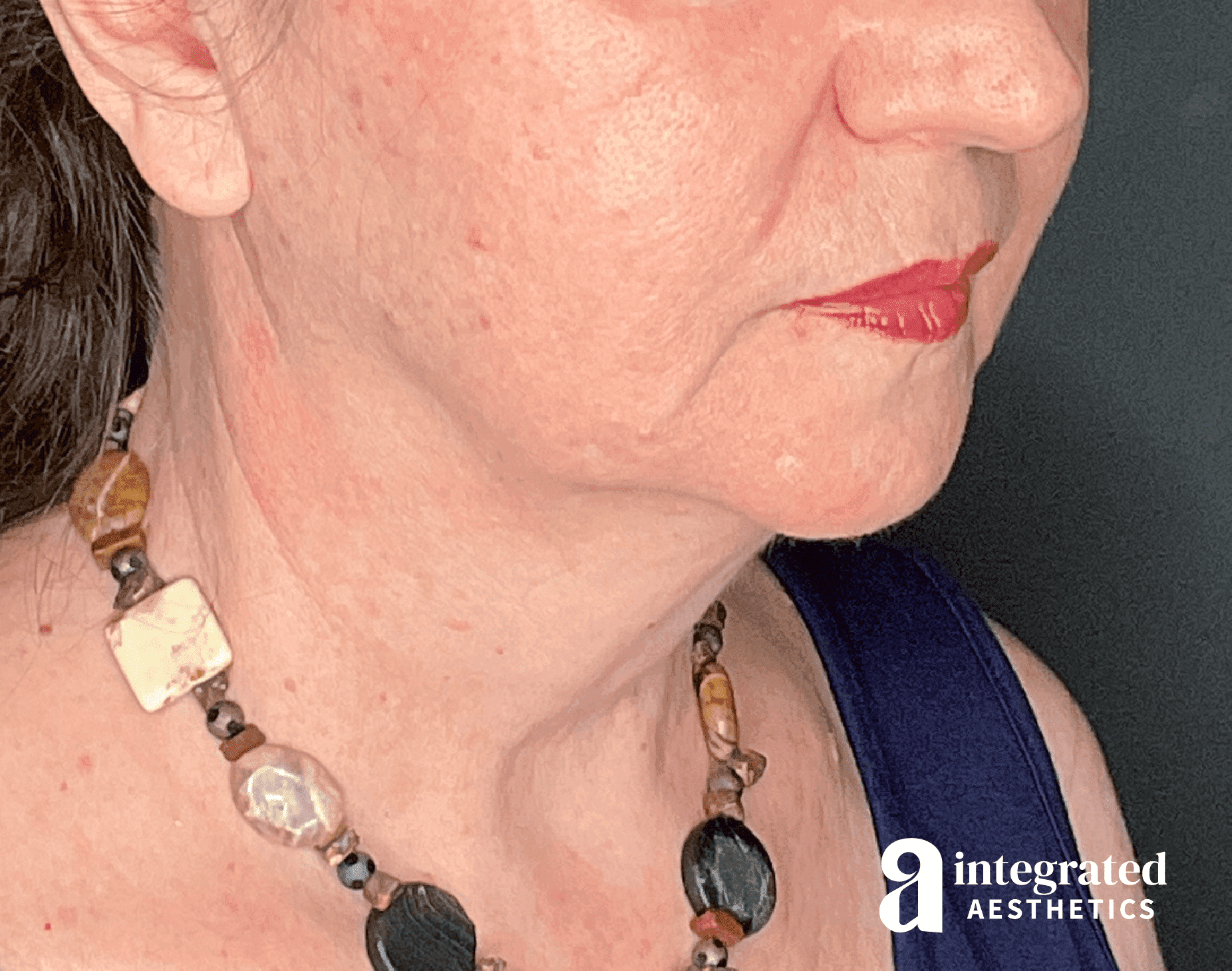 Before lower facelift and neck lift for tissue descent