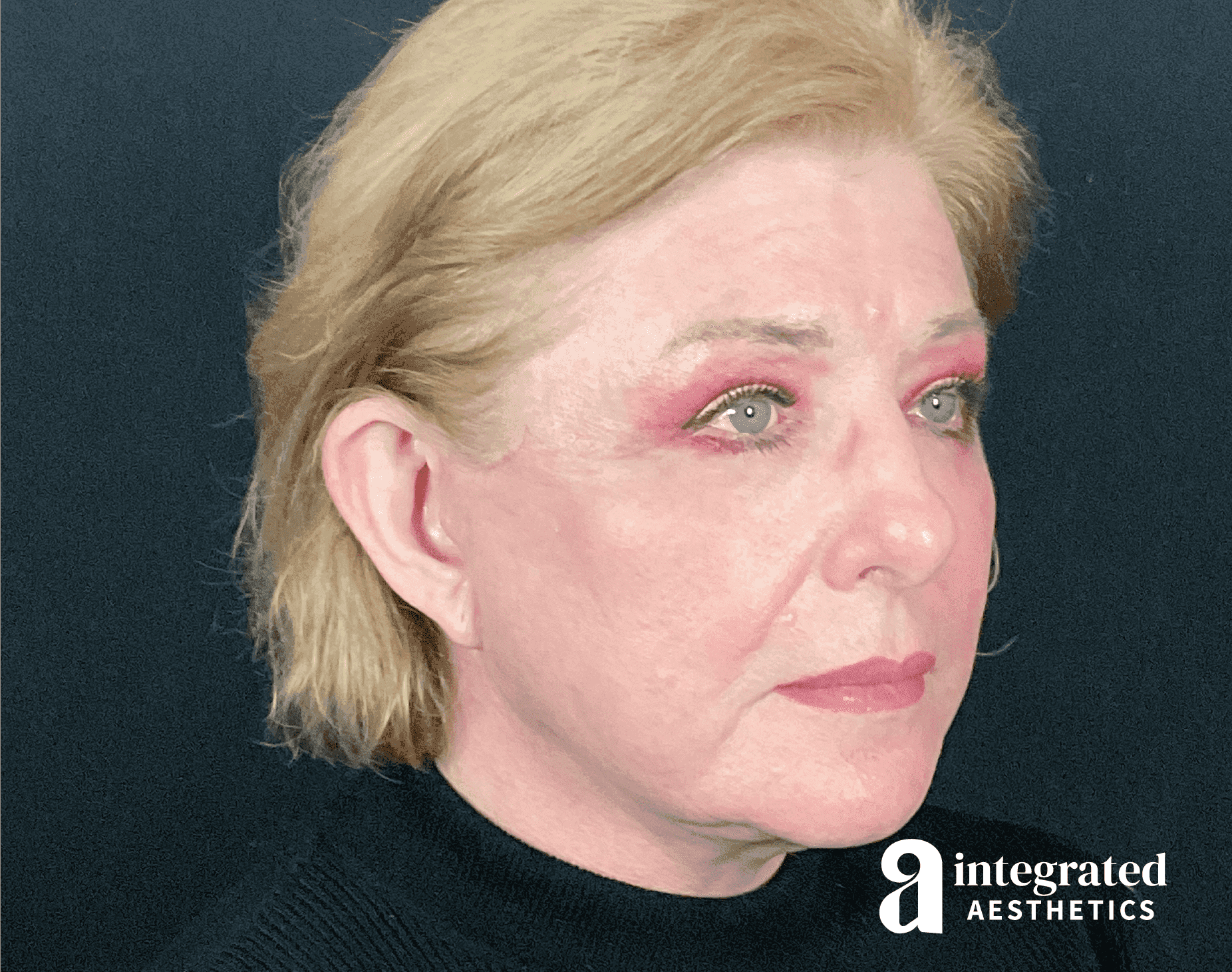 facelift patient after a rhytidectomy with Dr. Young Cho in The Woodlands, TX