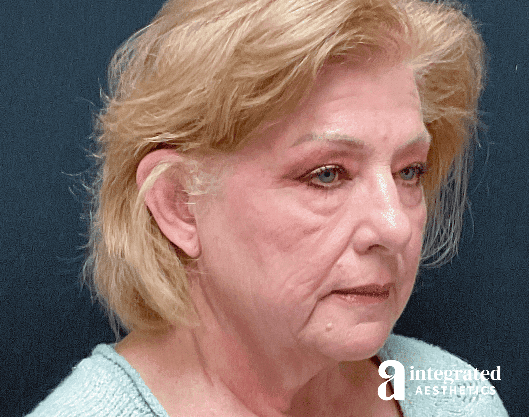 Facelift patient before surgery