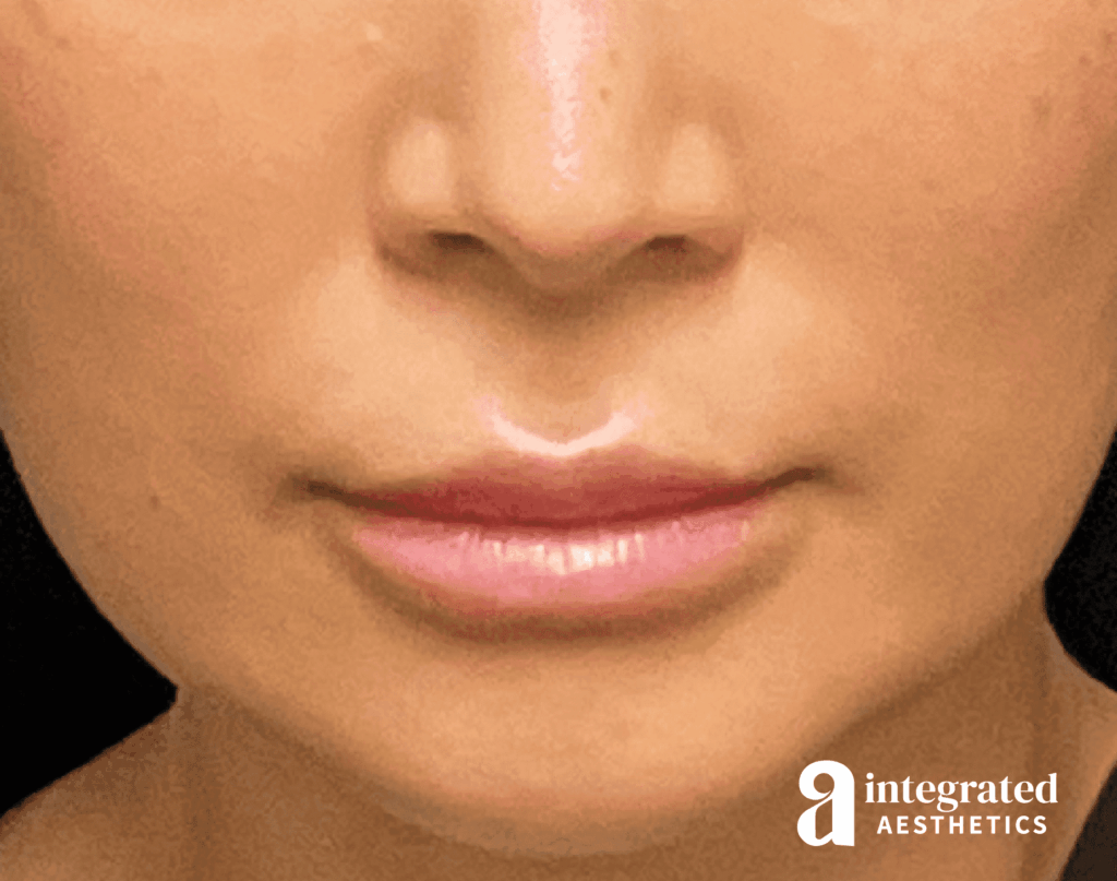 Lip Lift