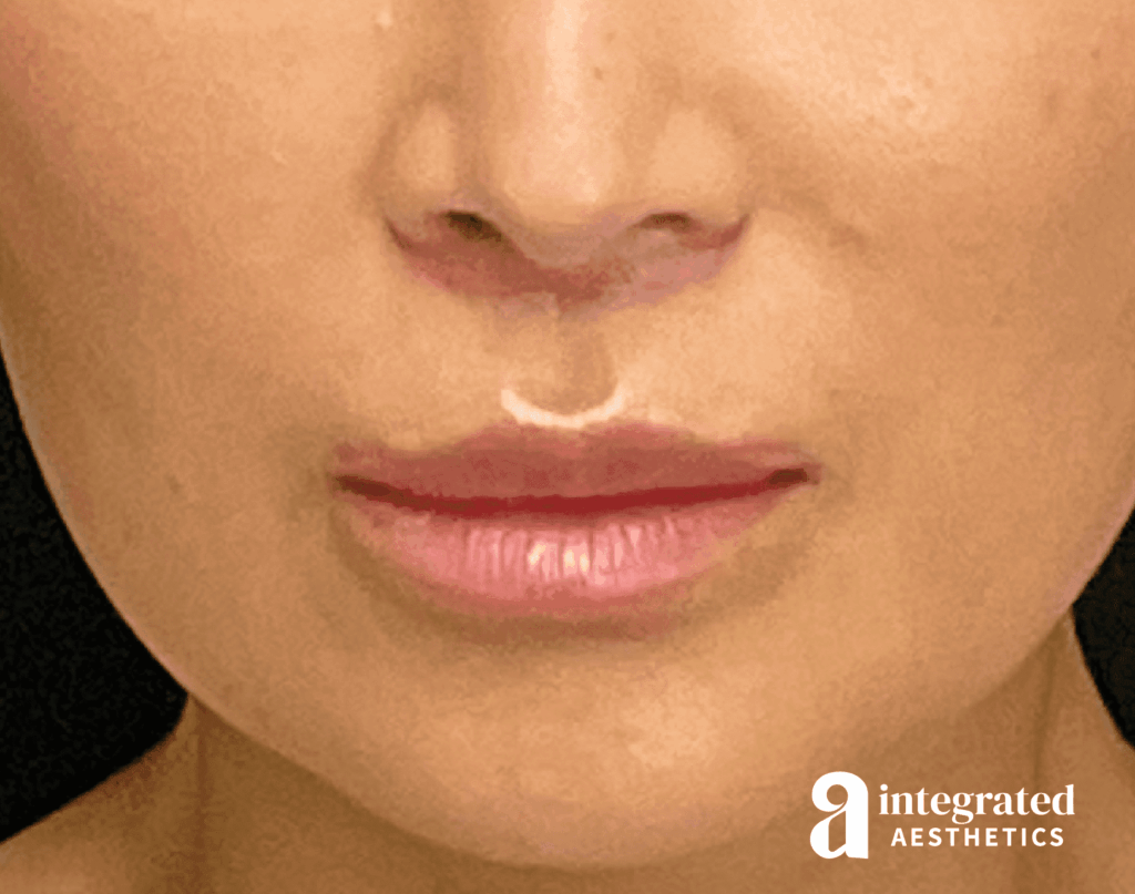 Lip Lift