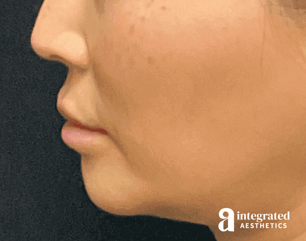 1679420740-19306_before_leftprofile.png