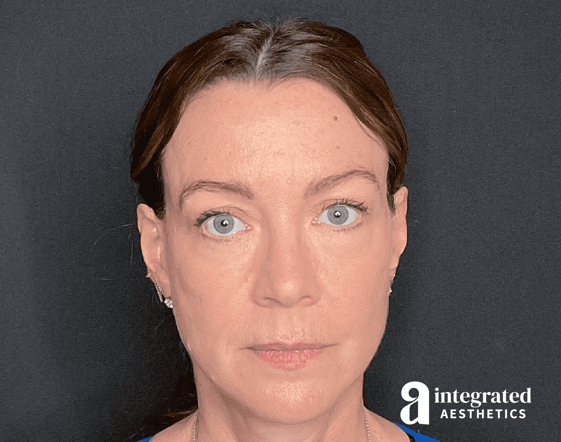 Sculptra