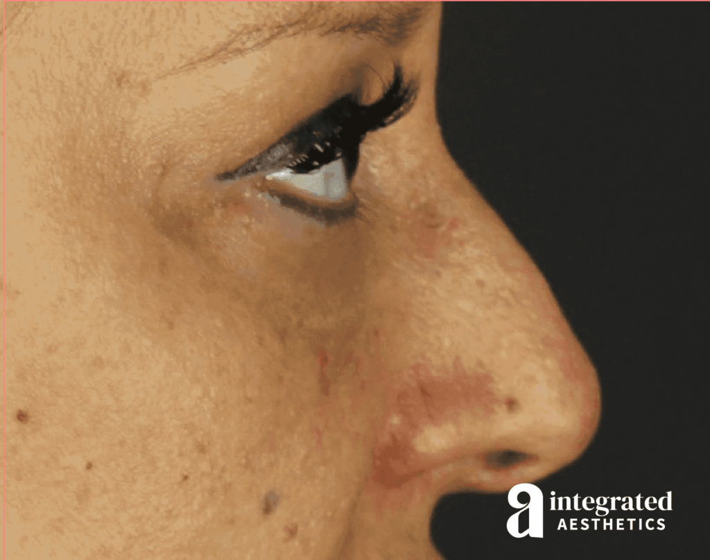 Rhinoplasty