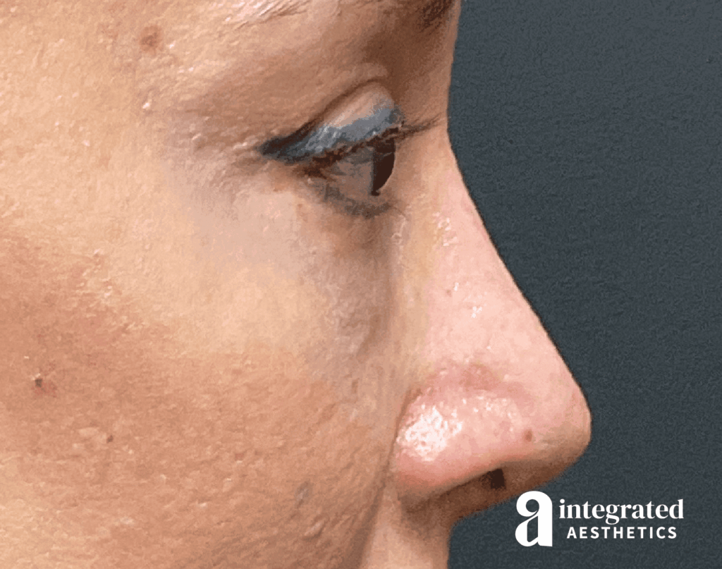 Rhinoplasty