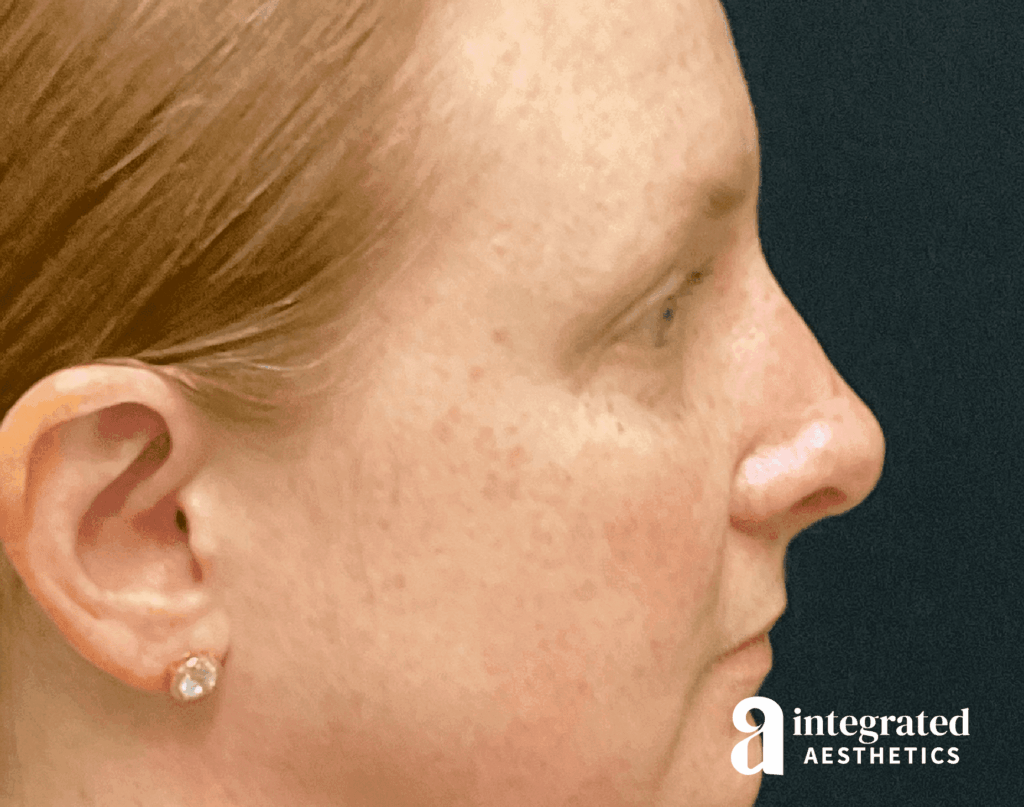 Rhinoplasty