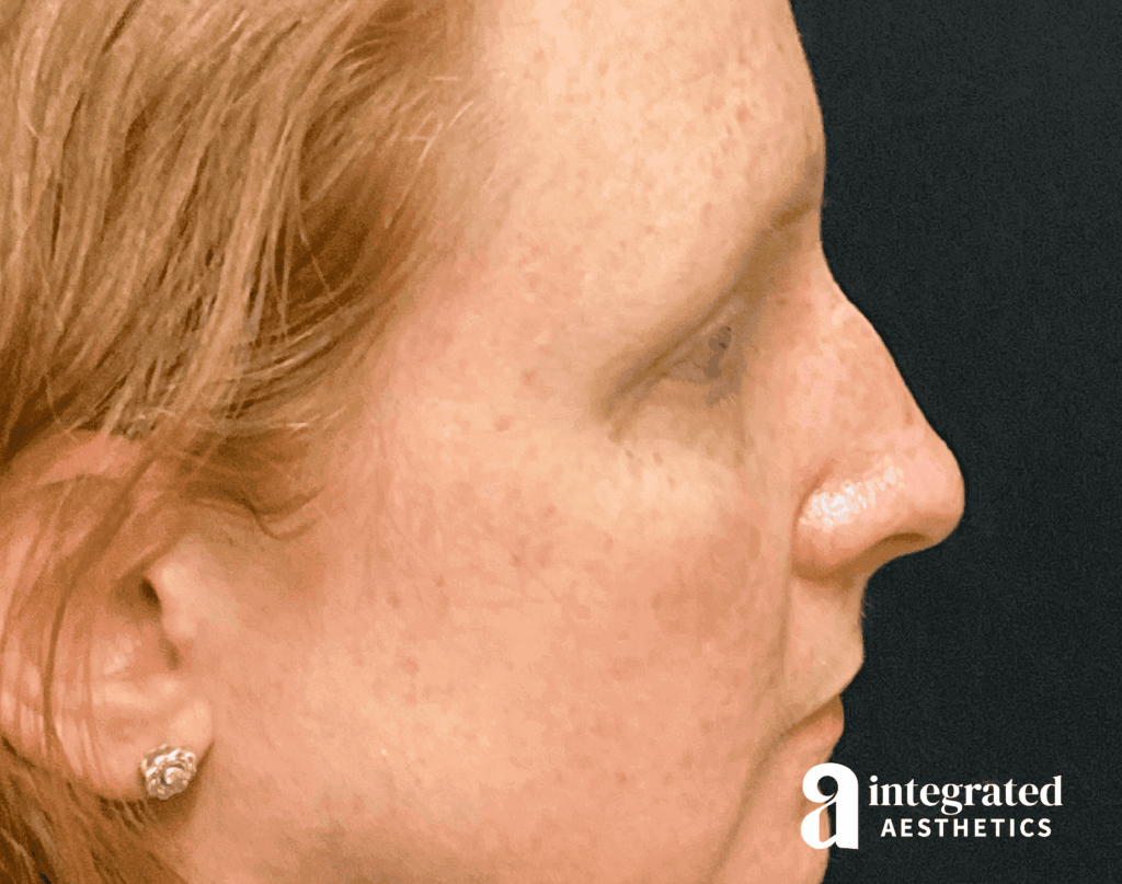 Rhinoplasty