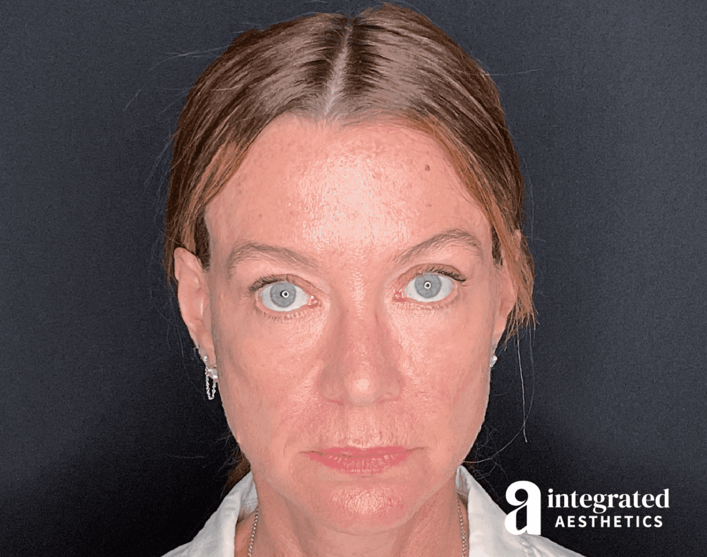 Sculptra