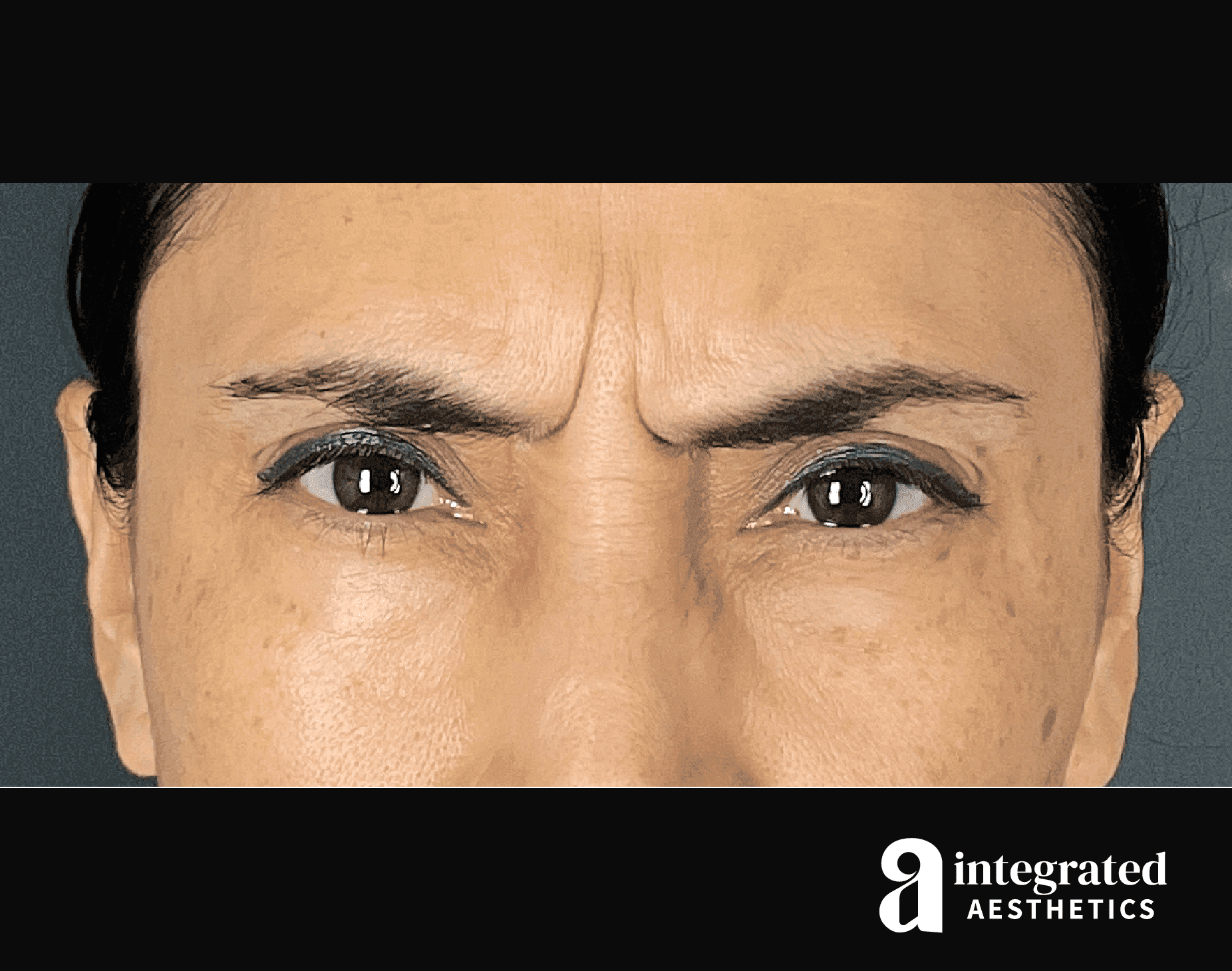 Wrinkle Relaxers