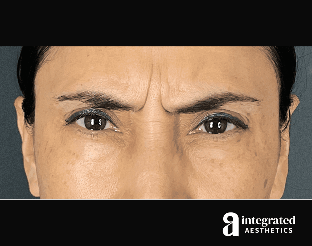 Botox