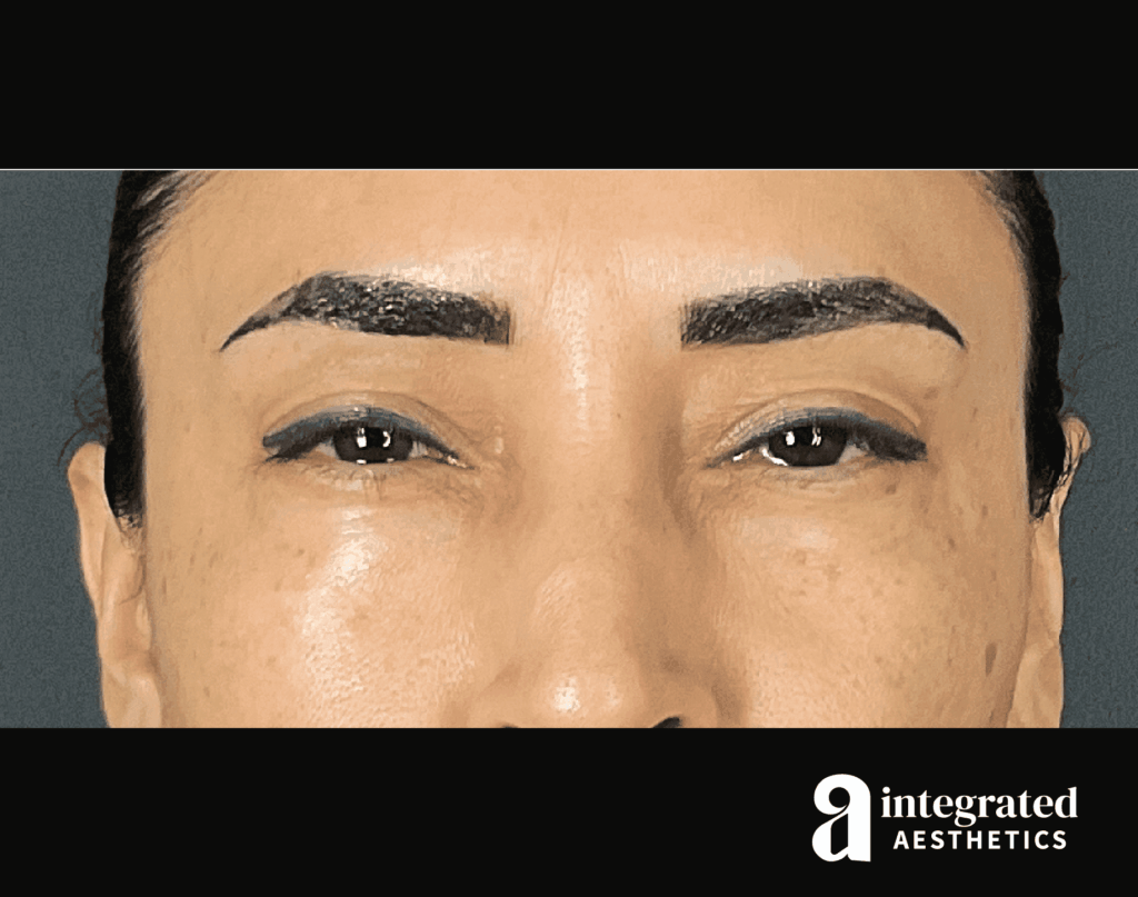 Botox