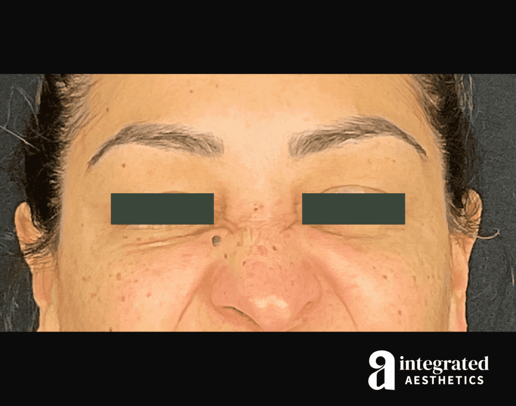 Botox