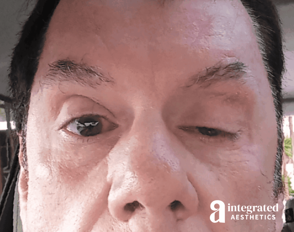 Resolved Aesthetic Complications
