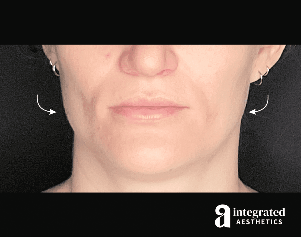 Wrinkle Relaxers