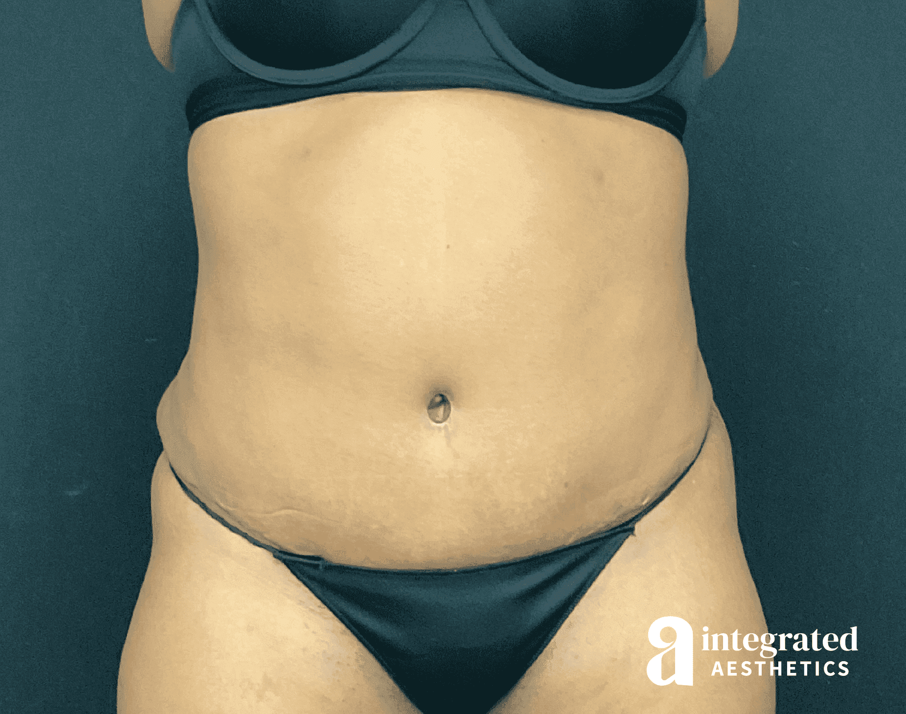 Tummy Tuck