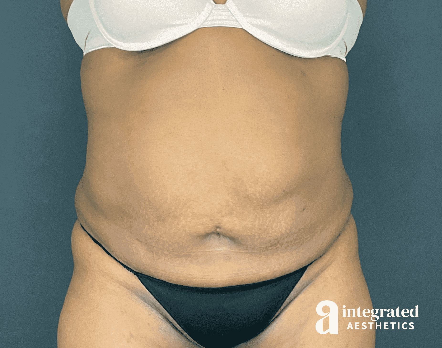 Tummy Tuck