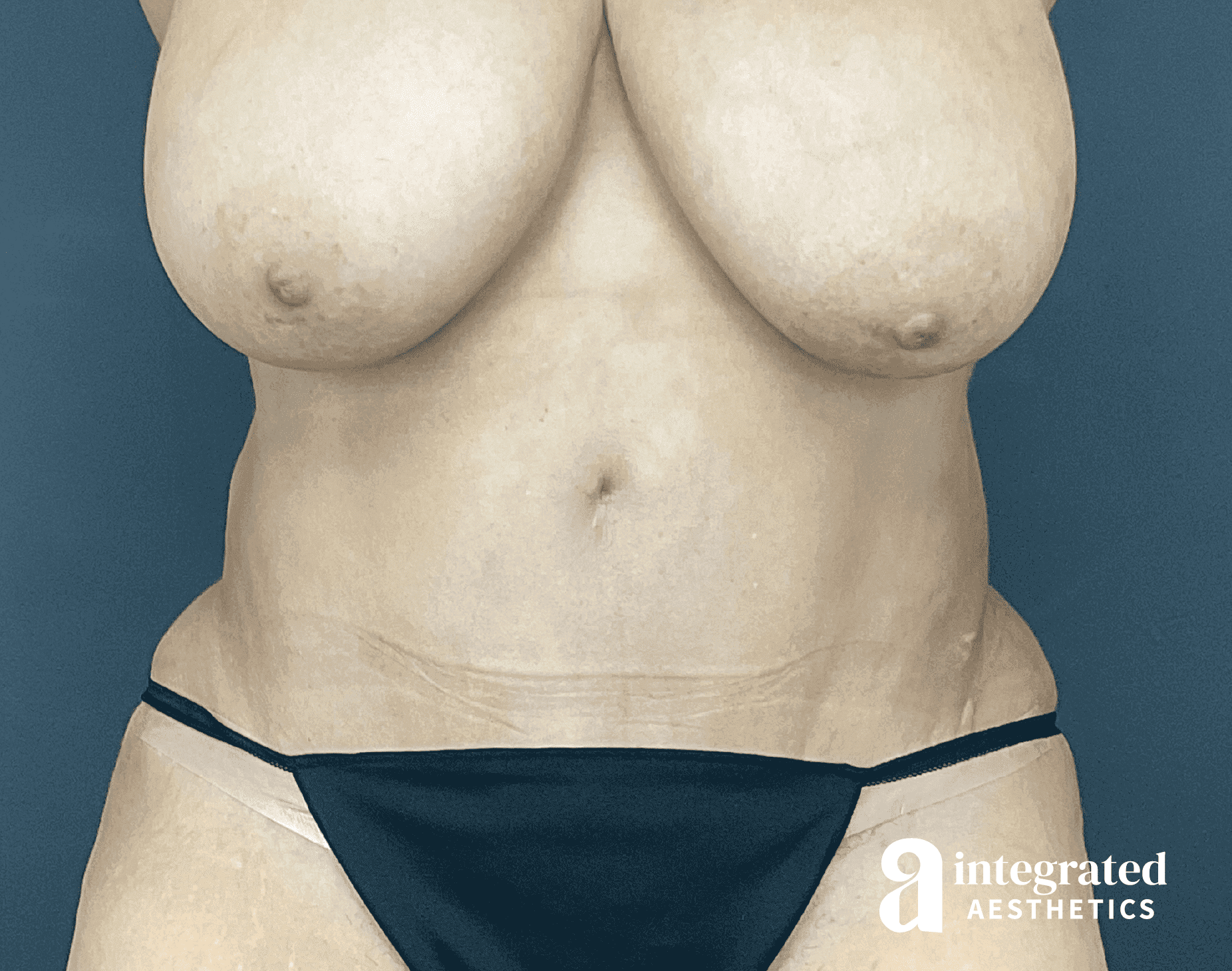Tummy Tuck