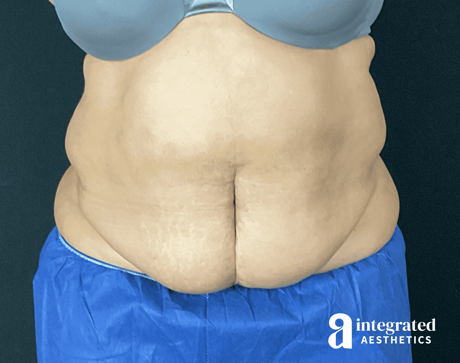 Tummy Tuck