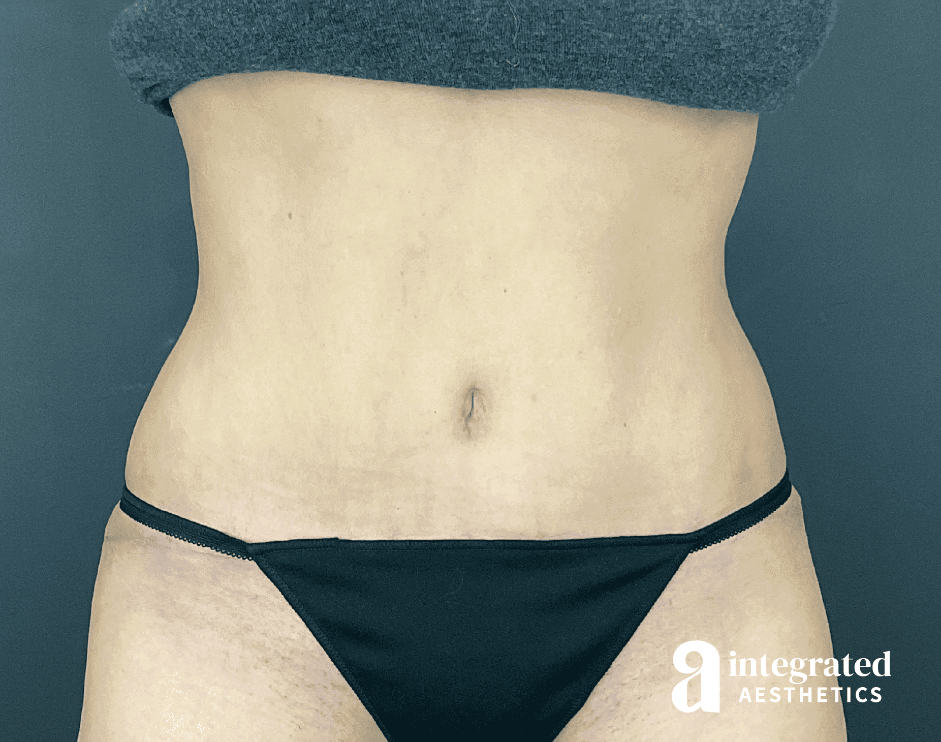 Tummy Tuck