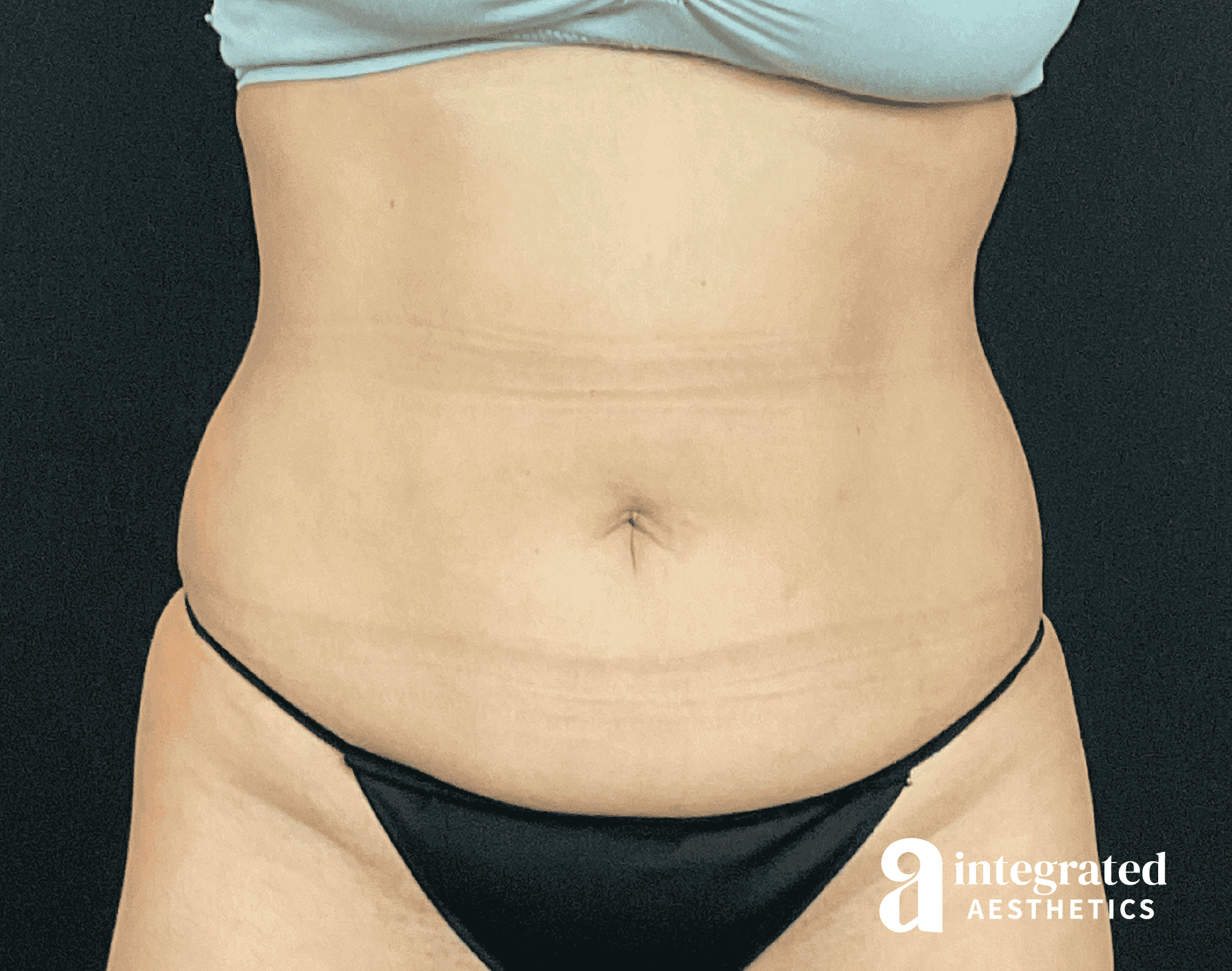 Tummy Tuck