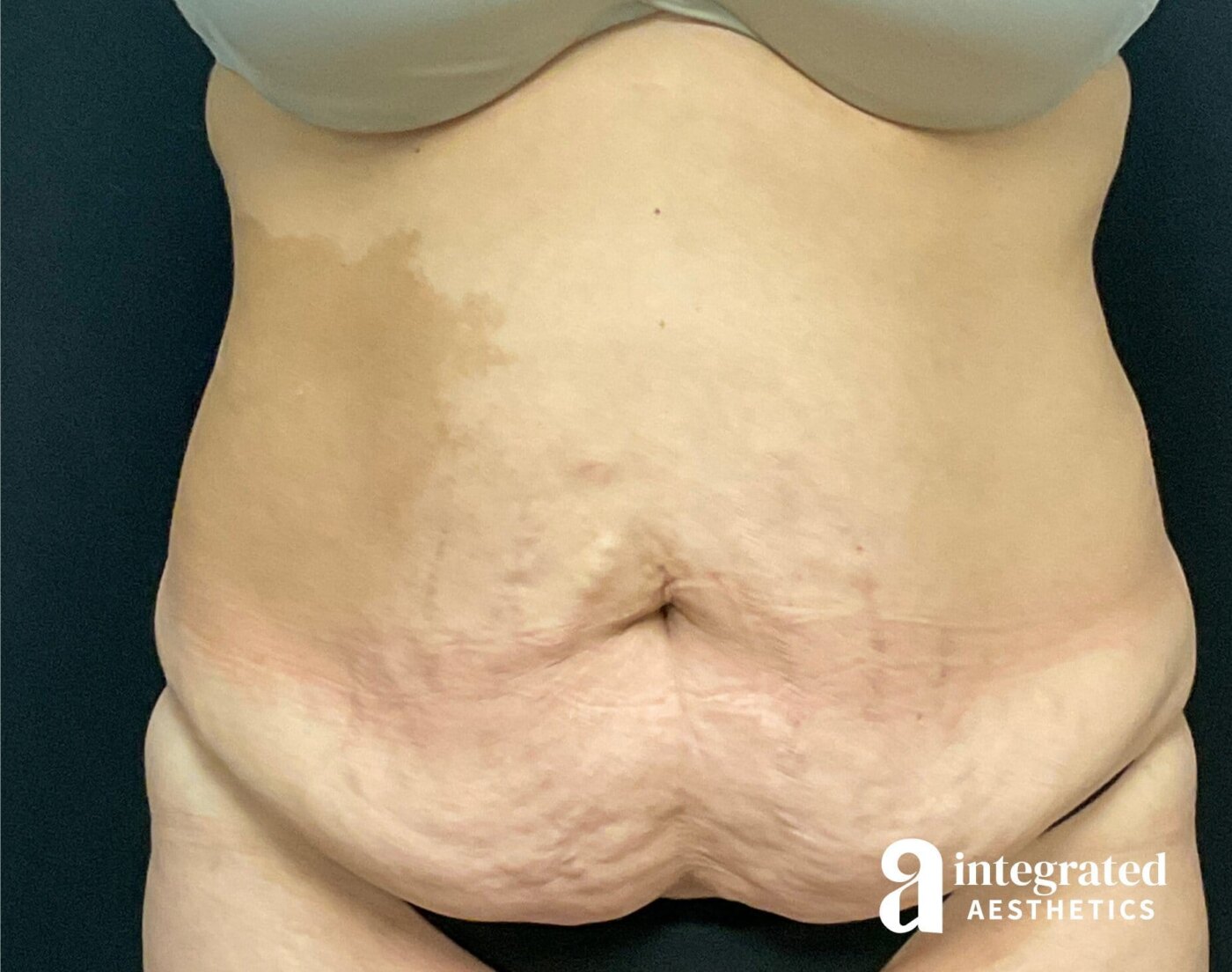 Tummy Tuck