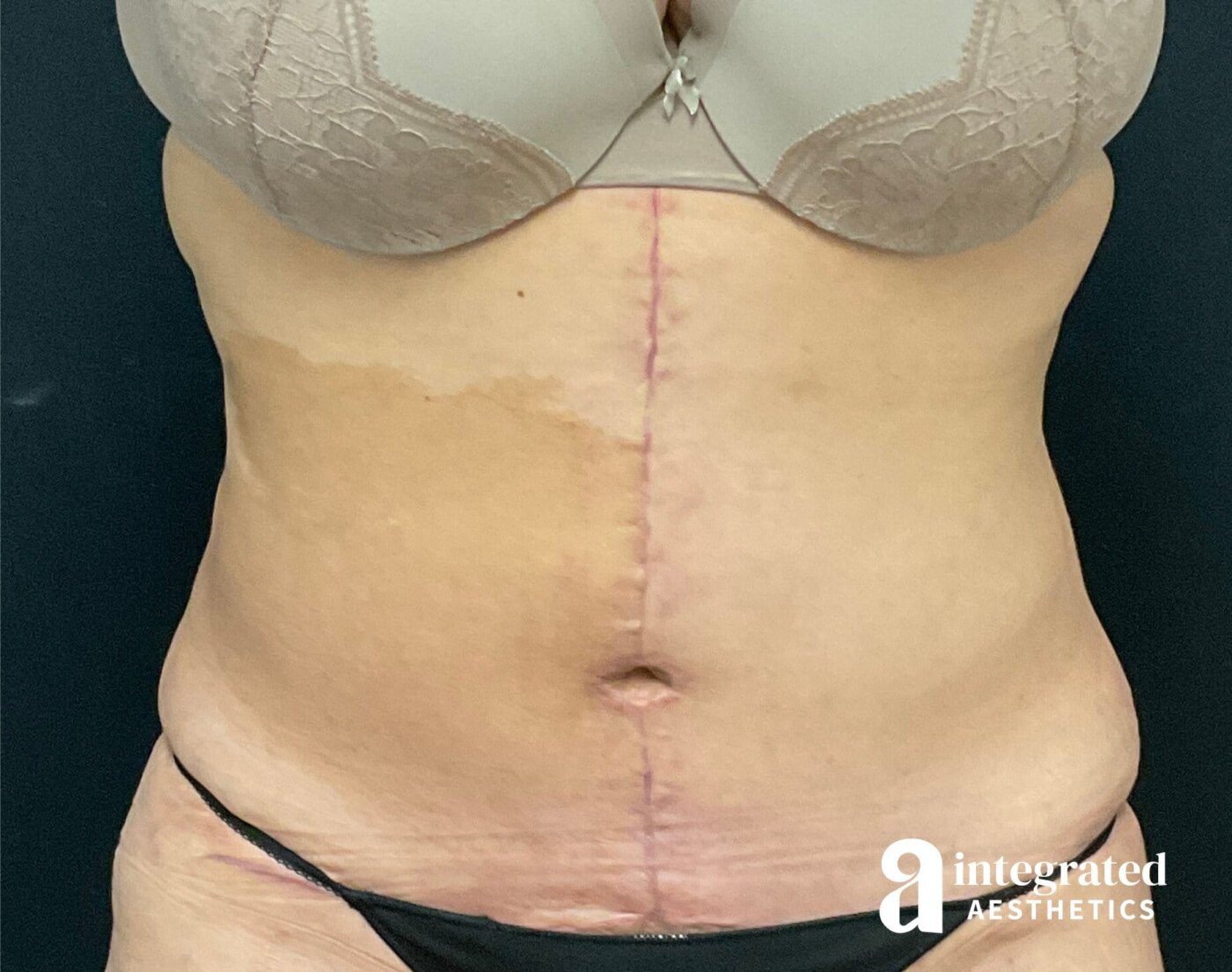 Tummy Tuck