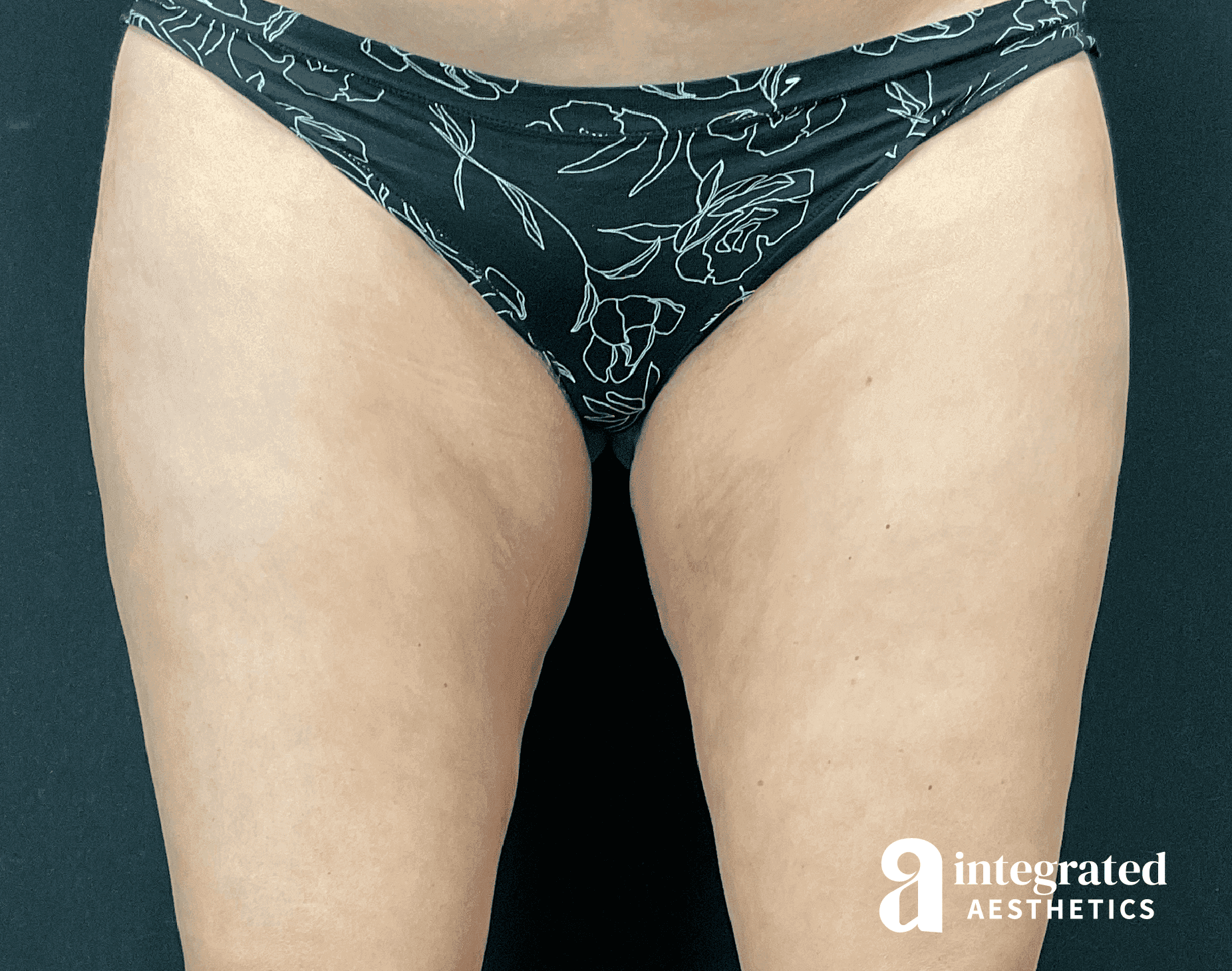1679426749-1778_after_frontthighs.png