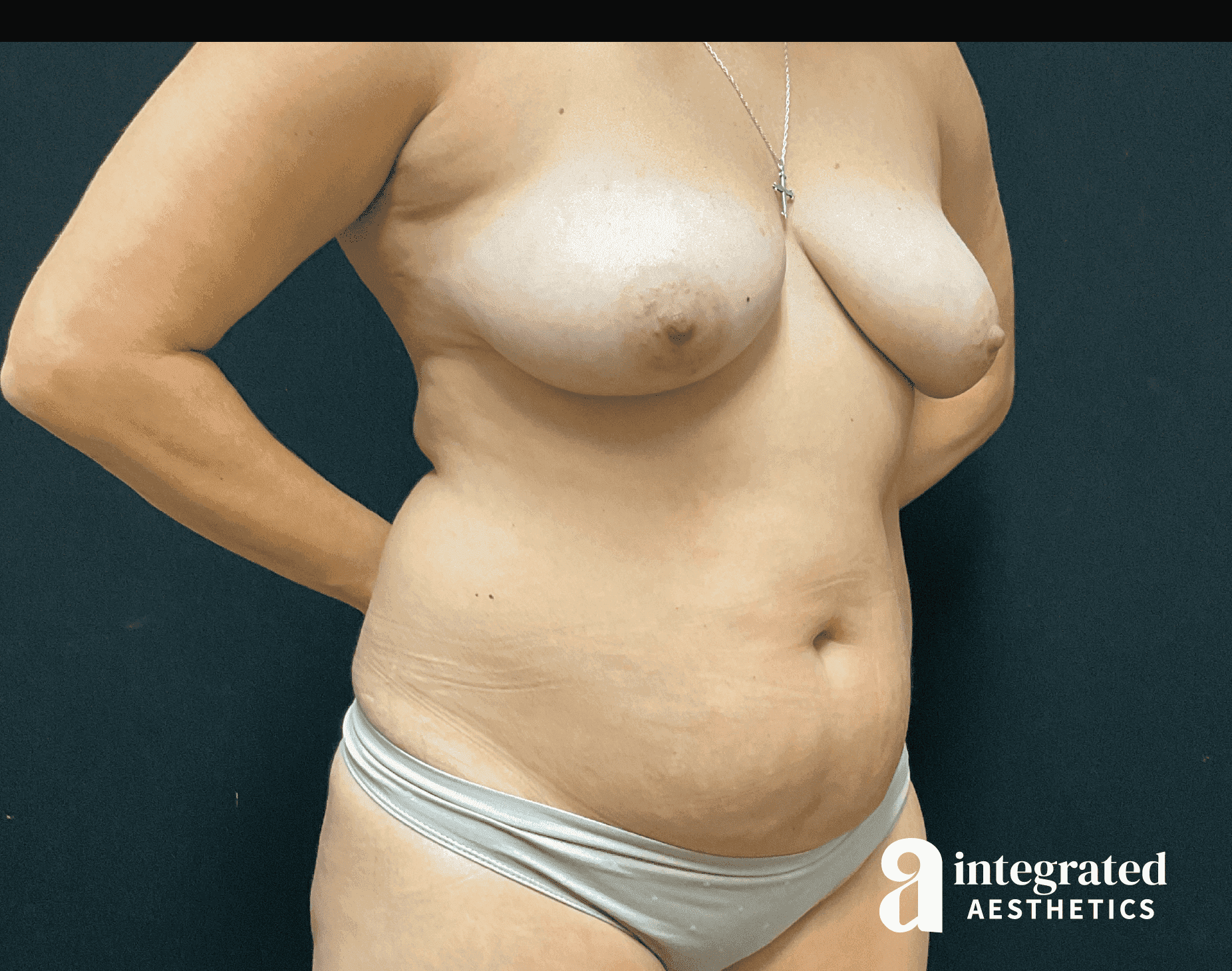 BodyTite