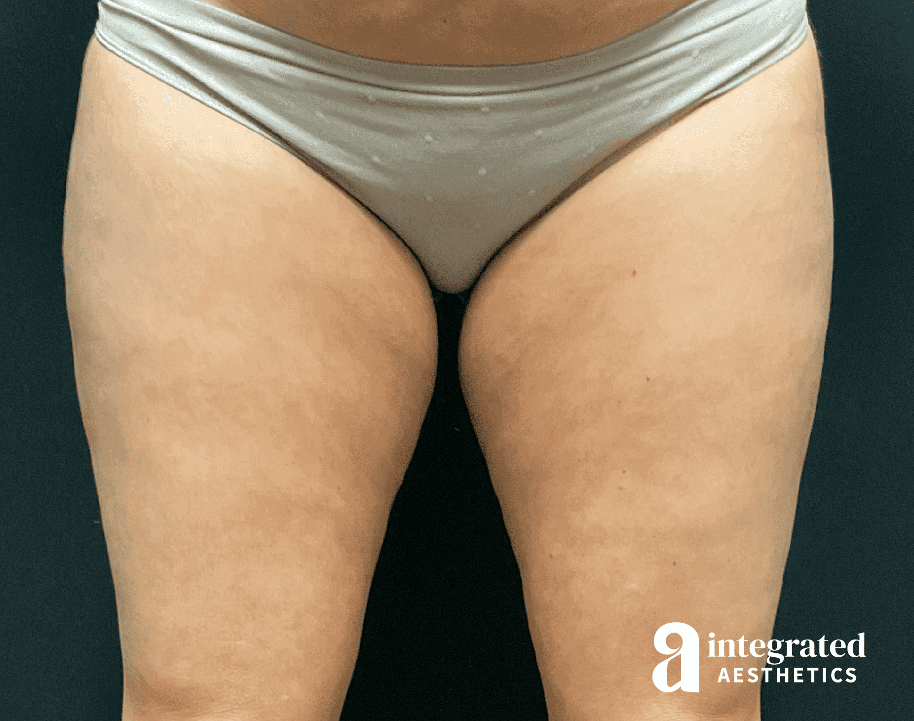 1679426783-1778_before_frontthighs.png