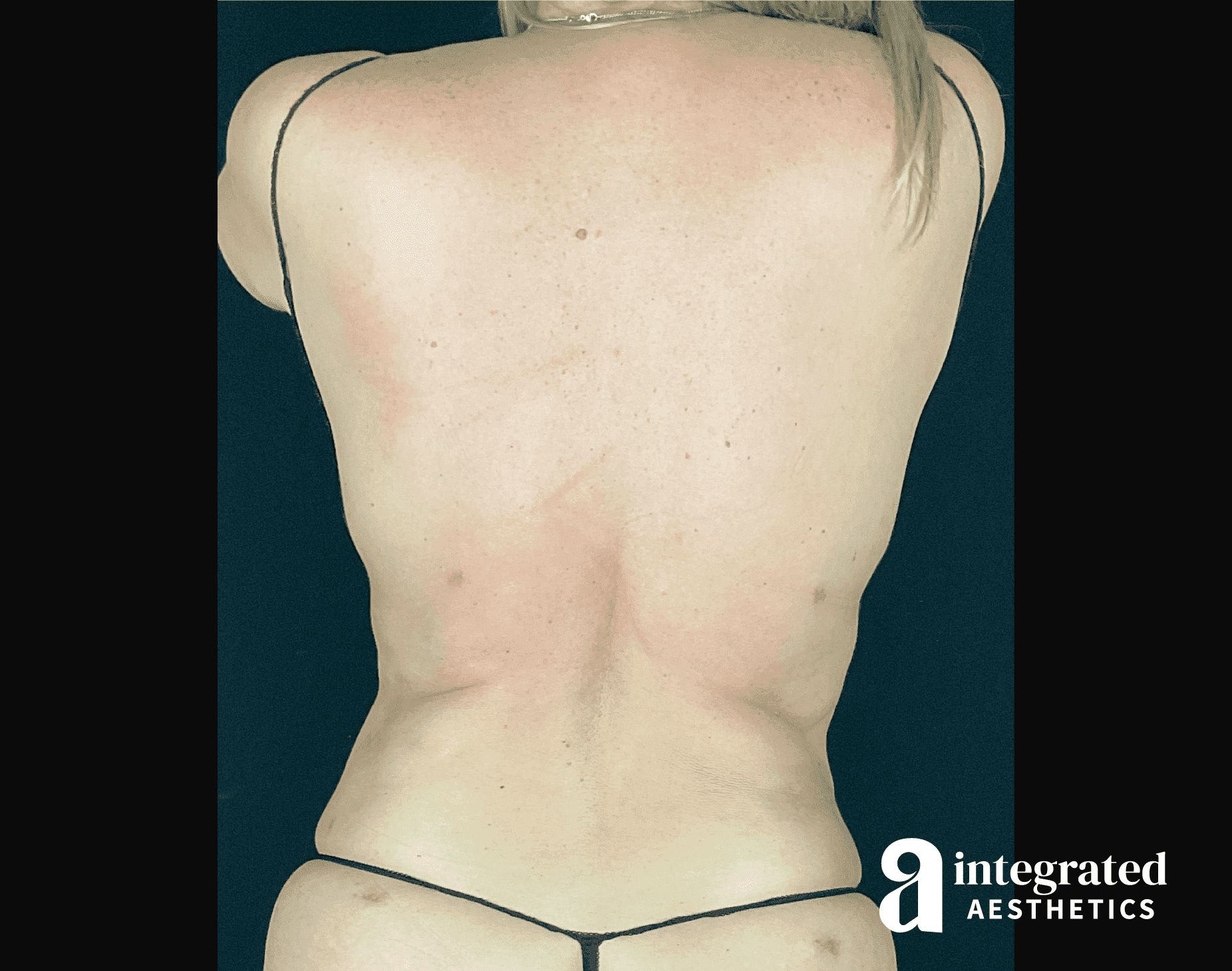 1679428187-23284_after_back.png