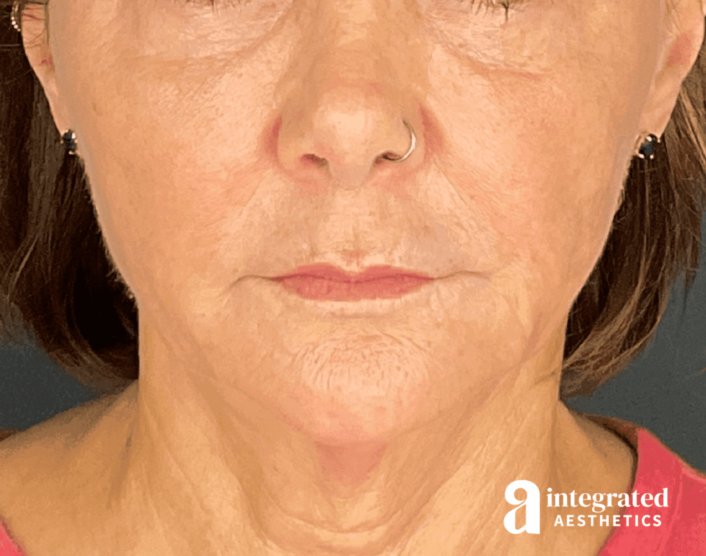 Dermal Fillers