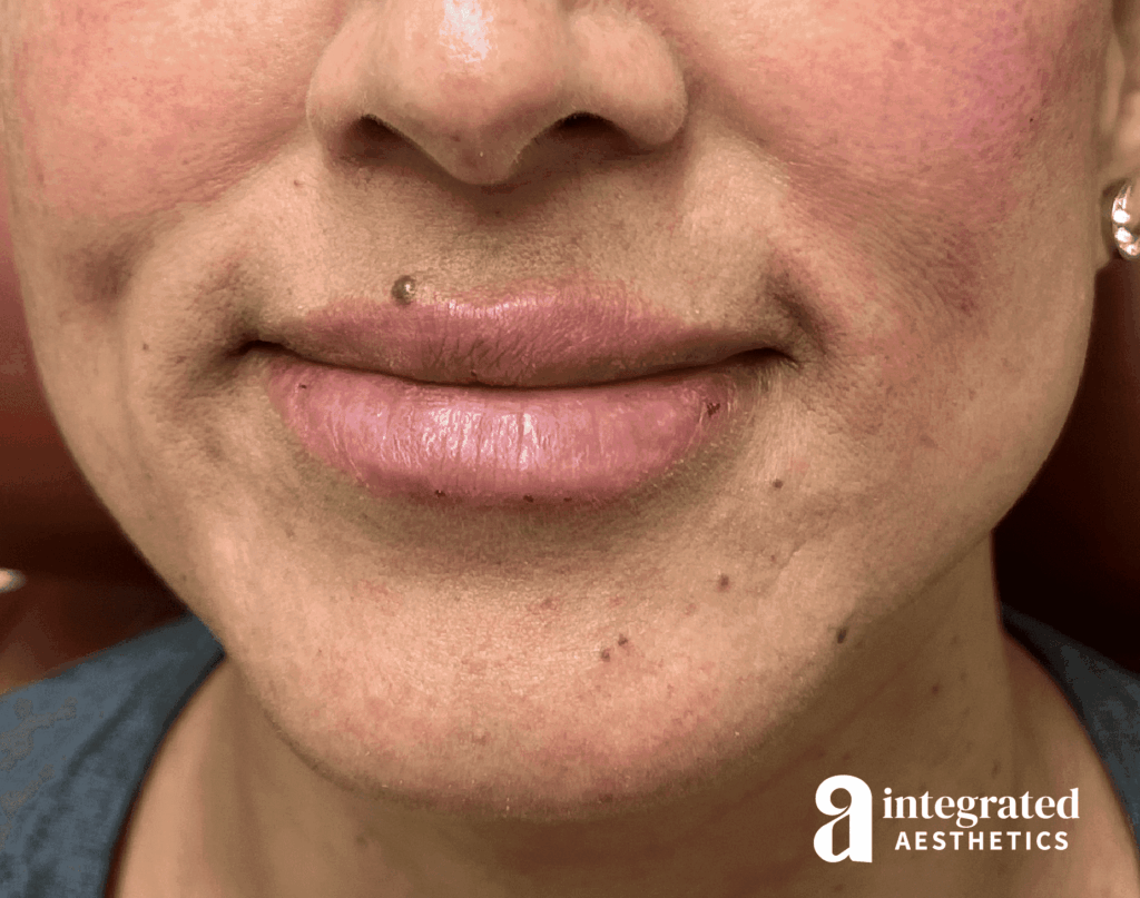 Lip Filler