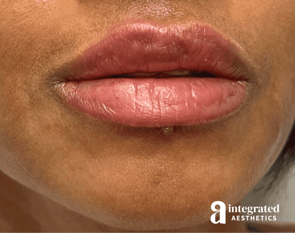 Lip Filler
