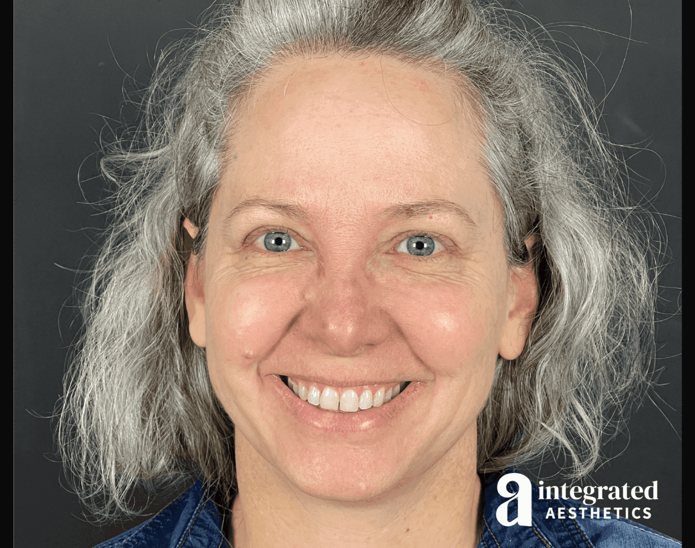 Before & after IPL photofacial treatment at Integrated Aesthetics