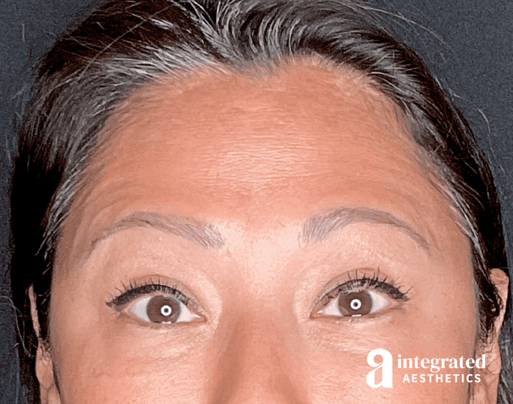 1684876644-botox8064_after_front_raisedeyebrows.png