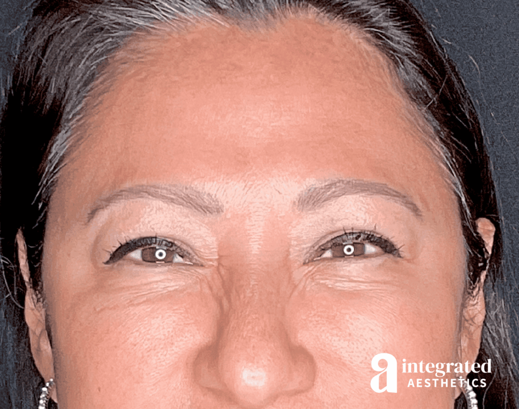 1684876666-botox8064_after_front_squint.png